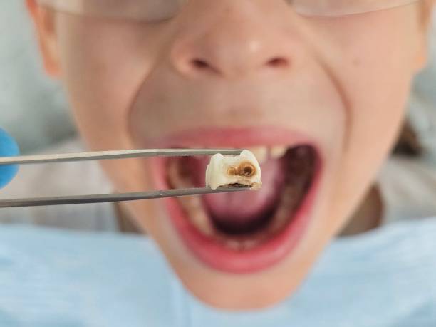 Best Emergency Tooth Extraction in Tipp City, OH